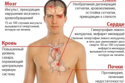 Симптомы артериальной гипертензии