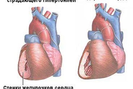 Проблема профилактики гипертонии